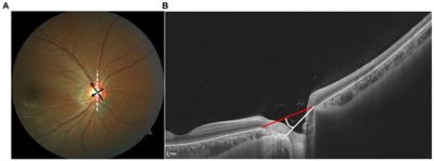 Multimodal imaging of optic nerve head abnormalities in high myopia